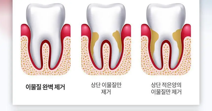 [리뷰이벤트] 알로코리아 덴픽션 휴대용 무선 구강세정기 AWF1 상세페이지 15